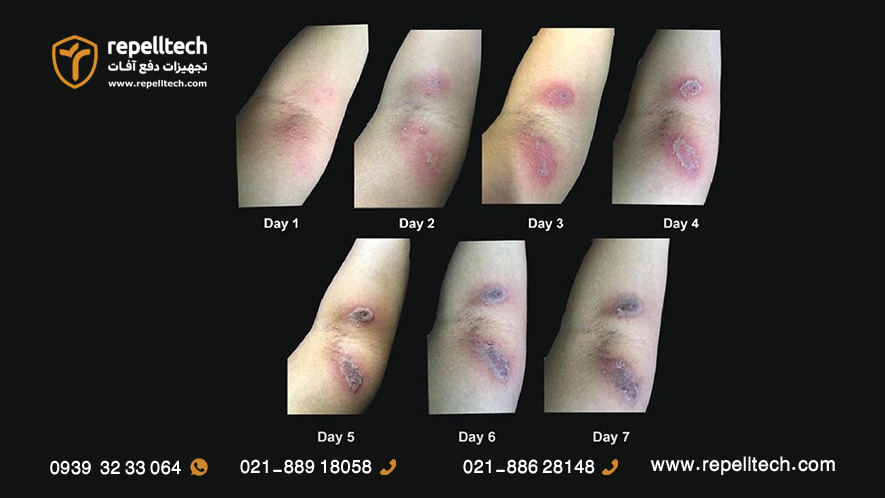 علائم اولیه و ثانویه نیش دراکولا از روز اول تا هفتم