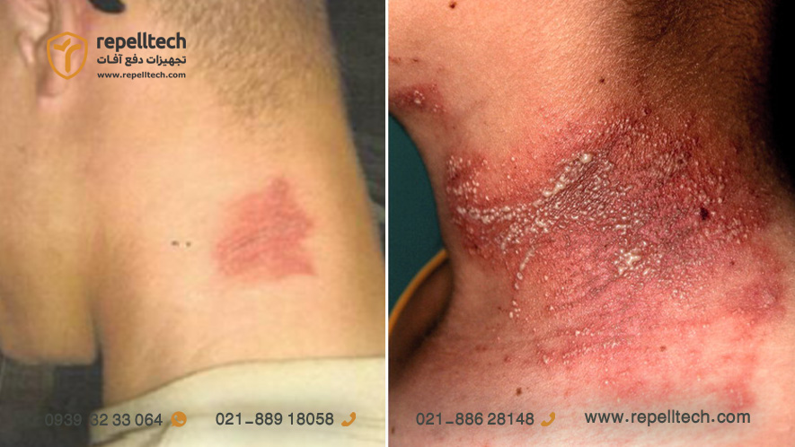 عکس جای نیش دراکولا