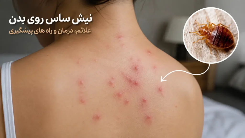 جای نیش ساس روی بدن